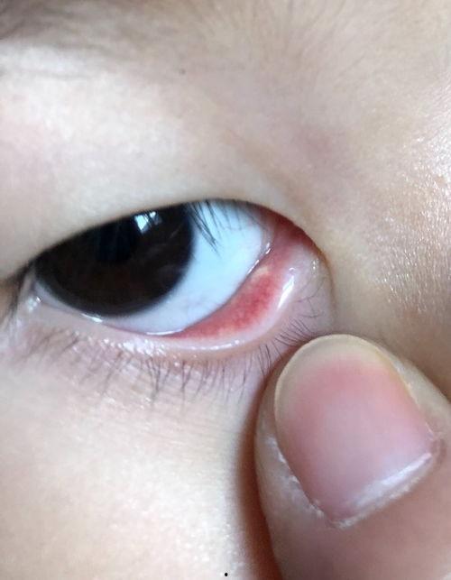 宝宝正常下眼睑图片,宝宝正常下眼睑特征解析